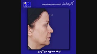 لیفت صورت و گردن