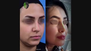 شش ماه بعد از جراحی زیبایی بینی اولیه | دکتر باستانی نژاد | بهترین جراح بینی