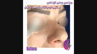 فیلم واقعی عمل بینی گوشتی اندودنتیکس