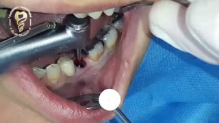 فیلم واقعی جراحی ایمپلنت