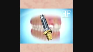 انیمیشن مراحل ایمپلنت دندان