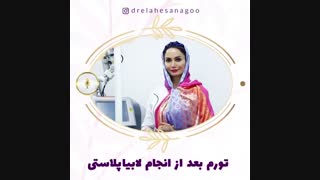 تورم بعد از انجام لابیاپلاستی