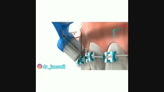 نحوه مسواک زدن در دوران ارتودنسی