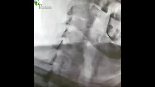 تنگی شدید شریان کاروتید داخلی به همراه سودوآنوریسم با گذاشتن استنت و بالون