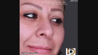 فیلم عمل بینی زنانه