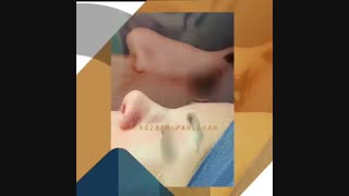 نمونه عمل بینی در حین عمل