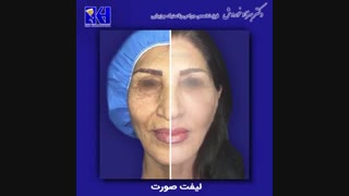 نمونه کار لیفت صورت