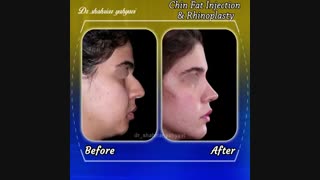 نمونه کار جراحی بینی و تزریق چربی به چانه