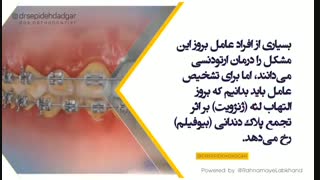 یکی از مشکلات رایج بیماران تحت درمان ارتودنسی التهاب لثه است | دکتر سپیده دادگر