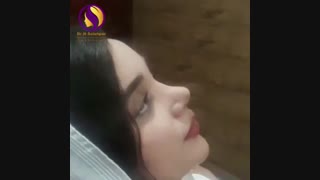 دو هفته پس از عمل بینی نیمه فانتزی