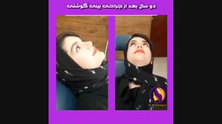 دو سال بعد از عمل بینی گوشتی