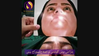 جراحی بینی گوشتی