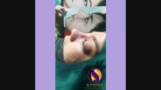 بلافاصله بعد از راینوپلاستی