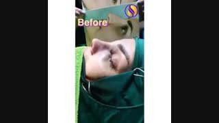 جراحی زیبایی بینی