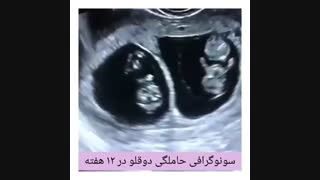 سونوگرافی دوقلو