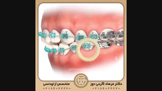 کش ارتودنسی مثلثی | دکتر فرهاد گرجی دوز