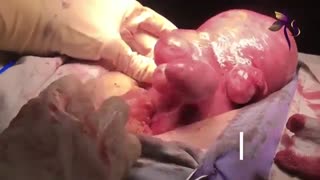 درمان فیبروم رحم