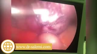 لاپاراسکوپی میوم رحم