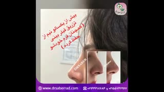 تزریق فیلر بینی