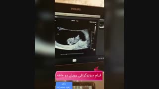 سونوگرافی