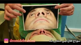 جراحی بینی ترمیمی توسط دکتر امید ابراهیمی بهترین جراح بینی در تهران