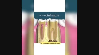 معالجه ی ریشه یا روت کانال تراپی چه گونه انجام می شود؟