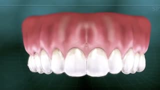 هوم بلیچینگ چیست؟