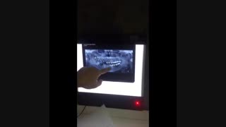 توضیح گرافی کاشت ایمپلنت بیمار