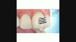 ارتودنسی چگونه انجام میشود؟