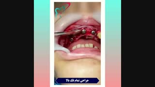فیلم جراحی کامل فک بالا