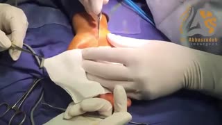 جراحى واقعی سندروم تونل کارپال