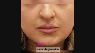 فیلم نتیجه هایفودرمانی تنها در یک جلسه