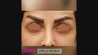 فیلم نمونه واقعی تزریق فیلر زیر چشم قبل و بعد
