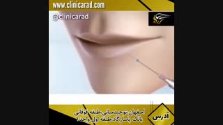 فیلر خط خنده تزریق ژل