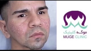 درمان جای جوش با tca ترمیم دندان