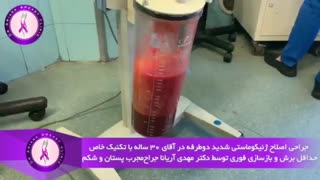 ژنیکوماستی شدید دوطرفه