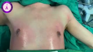 ژنیکوماستی دوطرفه در آقای 18 ساله