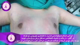 جراحی ژنیکوماستی شدید در آقای 20 ساله