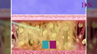 عمل جراحی ابدومینوپلاستی