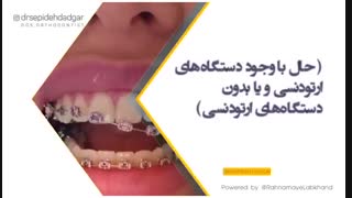 چرا این تصور وجود دارد که ارتودنسی باعث پوسیدگی دندان می‌شود؟ | دکتر سپیده دادگر