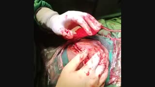 تروماتیک انسفالوسل اربیت و اتمویید