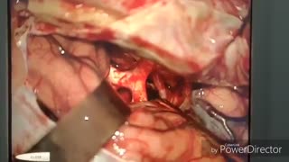 تومور بزرگ مغزی (بطن سوم )