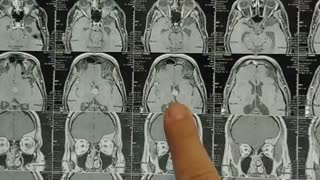 فیلم کیست کلویید بزرگ