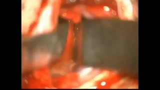 کیست کلویید بزرگ در دختر جوان