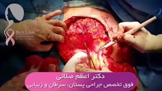 برداشتن کامل سینه (ماستکتومی کامل) در سرطان پیشرفته