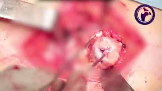 تعویض مفصل برای دررفتگی مادرزادی دو طرفه لگن نوع بالا