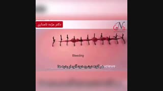 بخیه بعد از زایمان