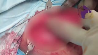 درمان جراحی دررفتگی مادرزادی مفصل ران در کودکان  جاندازی باز و استئوتومی