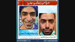 عمل بینی مردانه