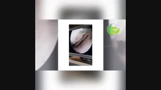 کندروپلاستی یا دبریدمان از طریق آرتروسکوپی
